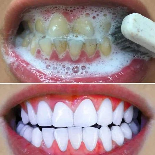 Como quitar el sarro de forma natural en casa