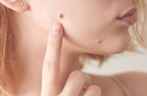 Olvídate de las cirugías: esto es lo que tienes que hacer para eliminar una verruga de tu cara