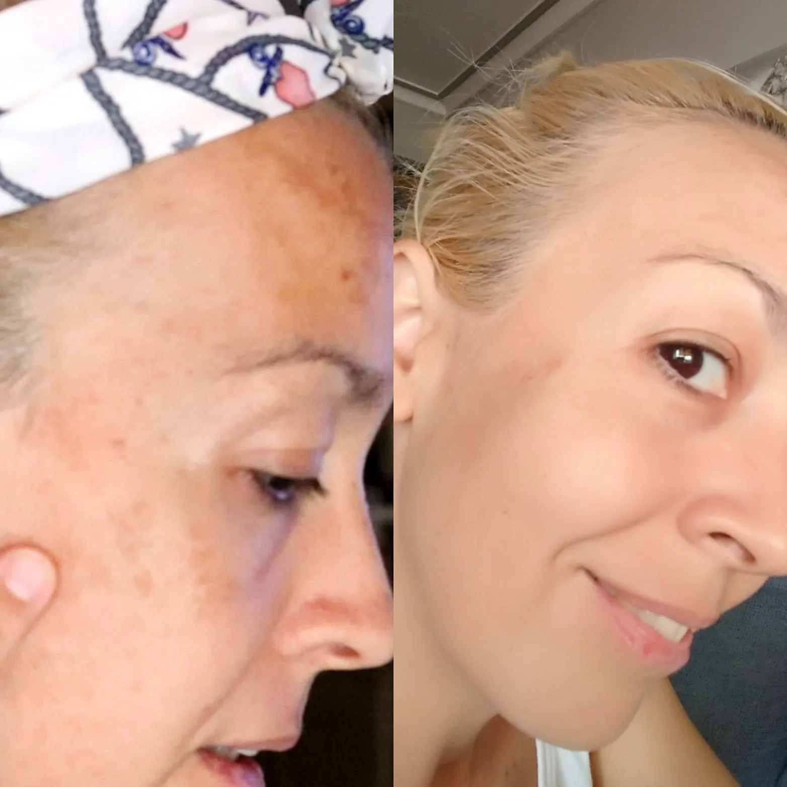 Mascarilla para eliminar manchas en la cara