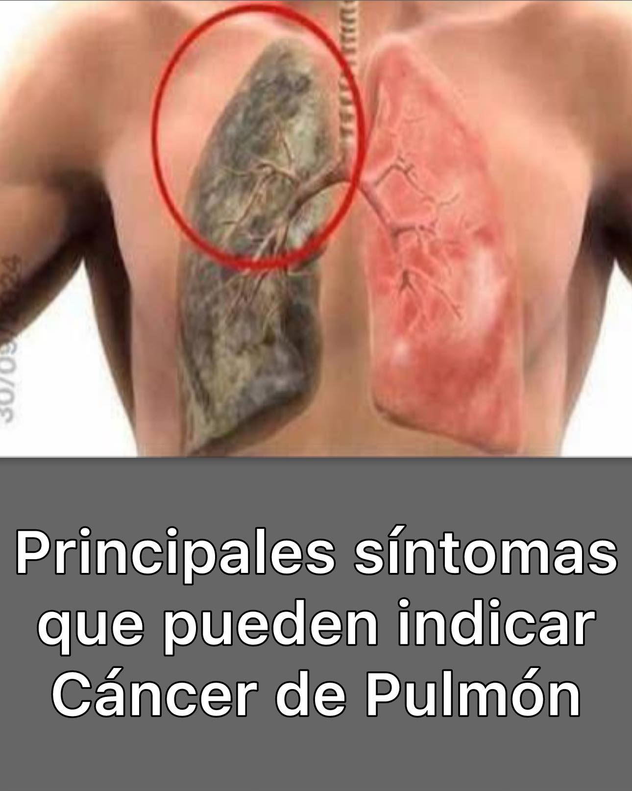 Cáncer de Pulmón: Síntomas que NO debes ignorar