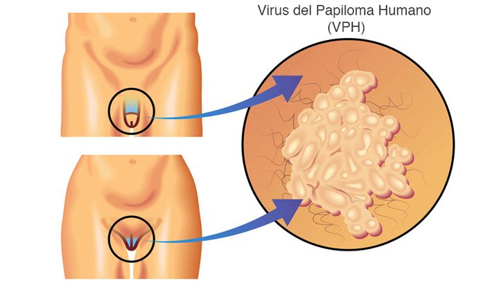 Estos son los síntomas del papiloma humano en hombres y mujeres: ¿Deberías preocuparte?