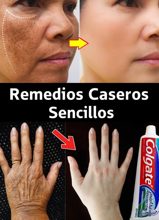 Blanqueador Casero: Colgate + Limón