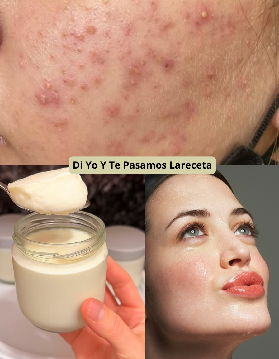 Cuidado para Tu Piel con Tendencia Acné