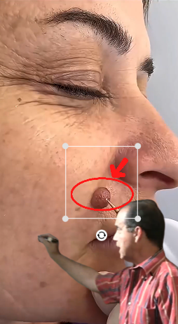 Este remedio casero seca las verrugas en días (100% natural)