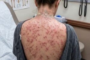 Enfermedad silenciosa en la piel: qué puede significar una erupción intensa después del contacto con ciertos desencadenantes