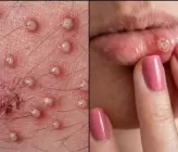 Cuáles son los primeros signos de algunas infecciones