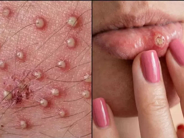 Cuáles son los primeros signos de algunas infecciones
